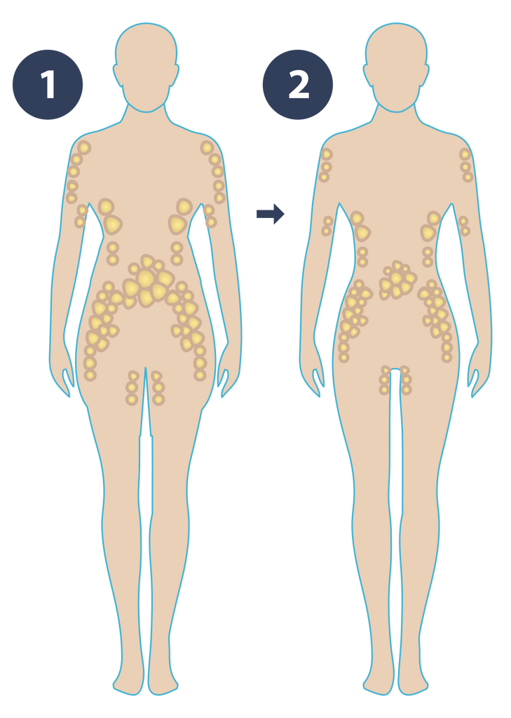 two bodies showing the impact of cold thermogenesis